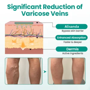 Alisanda® Varicose Veins Patch 11 Alisanda® Varicose Veins Patch