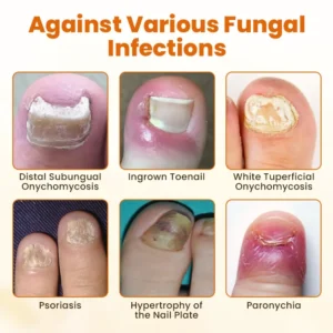 Alisanda® FungiBee Advanced Nail Repair Spray 10 Alisanda® FungiBee Advanced Nail Repair Spray