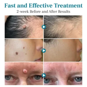 Alisanda™ LumeSkin Mole and Wart Removal Laser Pen 11 Alisanda™ LumeSkin Mole and Wart Removal Laser Pen