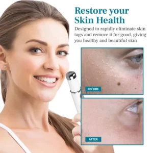 Alisanda™ LumeSkin Mole and Wart Removal Laser Pen 9 Alisanda™ LumeSkin Mole and Wart Removal Laser Pen